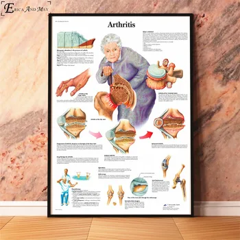 Anatomie Patologie Boli Graficul Postere Si Printuri Pictura Poze De Perete Pentru Camera De Zi Medicală Anatomie Decor Acasă